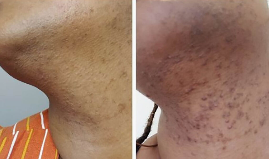 Affordable Laser Hair Removal